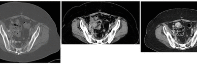 A recurrent platinum refractory ovarian cancer patient with a partial response after RRx-001 resensitization to platinum doublet