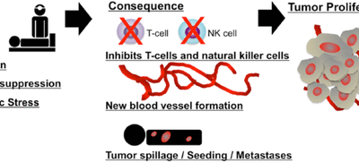 Abscopal benefit of surgery in 3 immunotherapy-treated patients with unresectable cancer