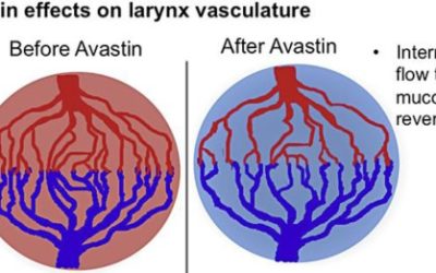 Dysphonia after bevacizumab rechallenge: A case report.