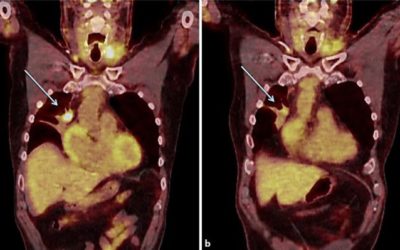 Flushing out carcinoid syndrome: Beneficial effect of the anticancer epigenetic agent RRx-001 in a patient with a treatment-refractory neuroendocrine tumor