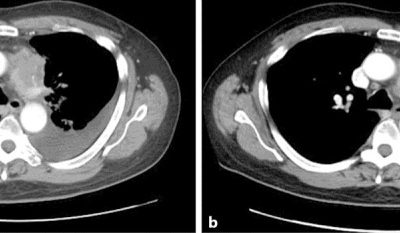 RRx-001 in refractory small-cell lung carcinoma: A case report of a partial response after a third reintroduction of platinum doublets.