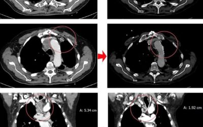 Partial response in an RRx-001 primed patient with refractory small-cell lung cancer after a third introduction of platinum doublets.