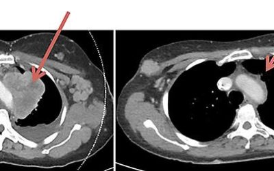 RRx-001 priming of PD-1 inhibition in the treatment of small cell carcinoma of the vagina: A rare gynecological tumor.