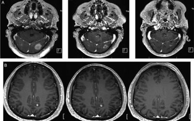 Concurrent whole brain radiotherapy and RRx-001 for melanoma brain metastases