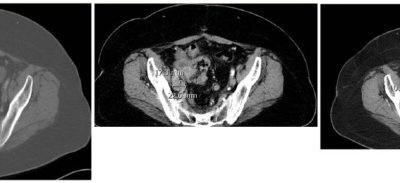 A Recurrent Platinum Refractory Ovarian Cancer Patient With a Partial Response After RRx-001 Resensitization to Platinum Doublet.