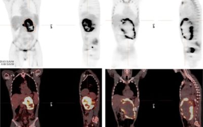 RRx-001-Induced Tumor Necrosis and Immune Cell Infiltration in an EGFR Mutation-Positive NSCLC with Resistance to EGFR Tyrosine Kinase Inhibitors: A Case Report.