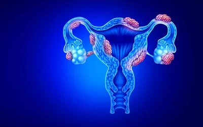 What is Endometriosis?