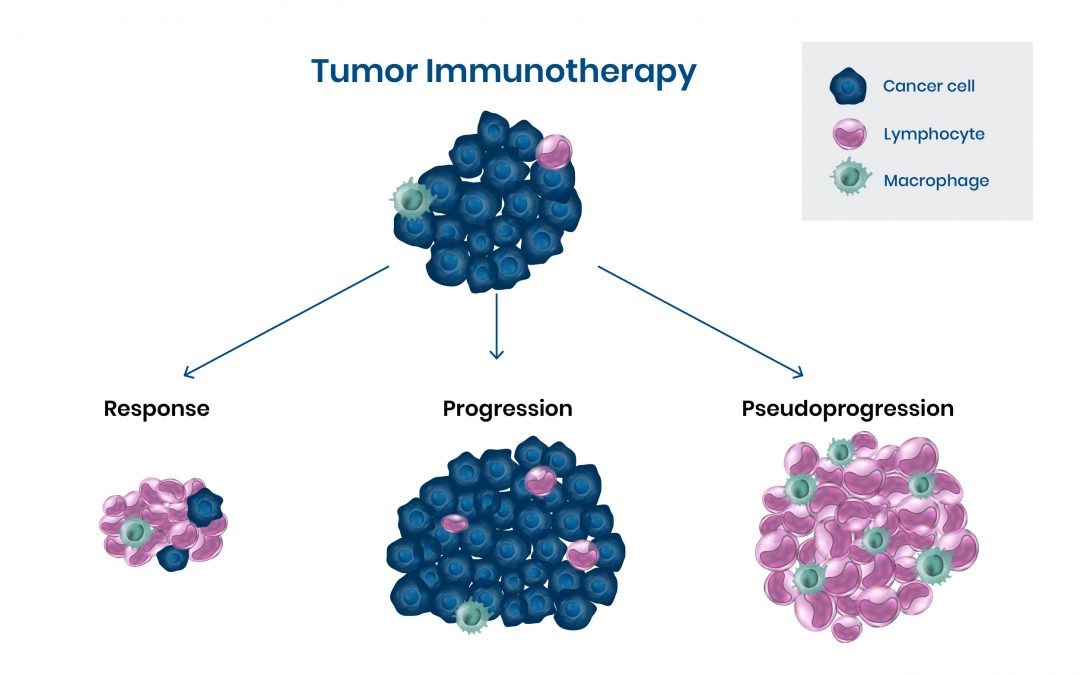 Pseudoprogression